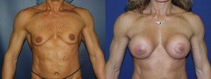 Esse Plastic Surgery breast enhancement