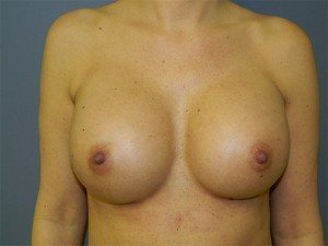 Esse Plastic Surgery breast enhancement post op