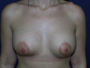 Esse Plastic Surgery breast enhancement