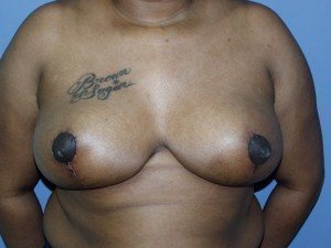 Esse Plastic Surgery breast reduction