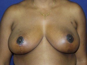 Esse Plastic Surgery breast reduction