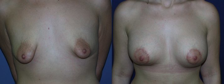, Breast Revision Gallery