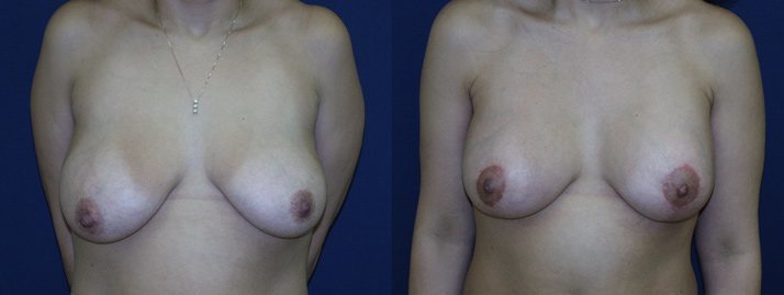 , Breast Enhancement 4
