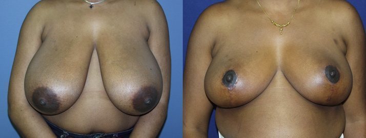 , Breast Reduction 2