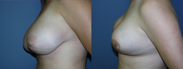, Breast Reduction Gallery
