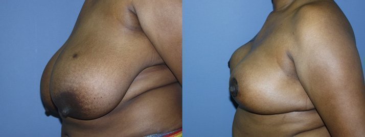 , Breast Reduction 1