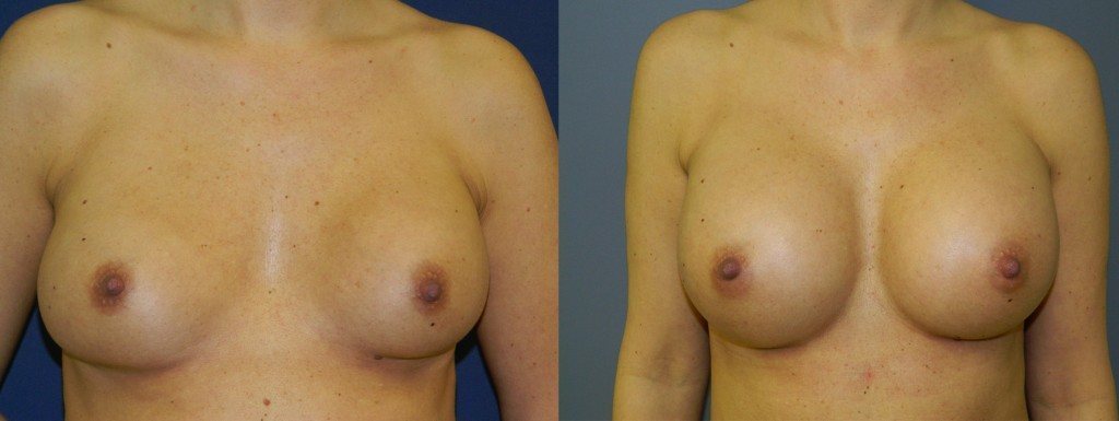 , Breast Enhancement 1