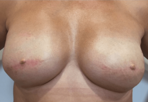 , Breast Reconstruction 1