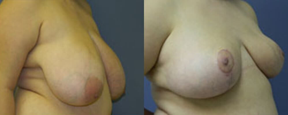 , Breast Reduction Gallery