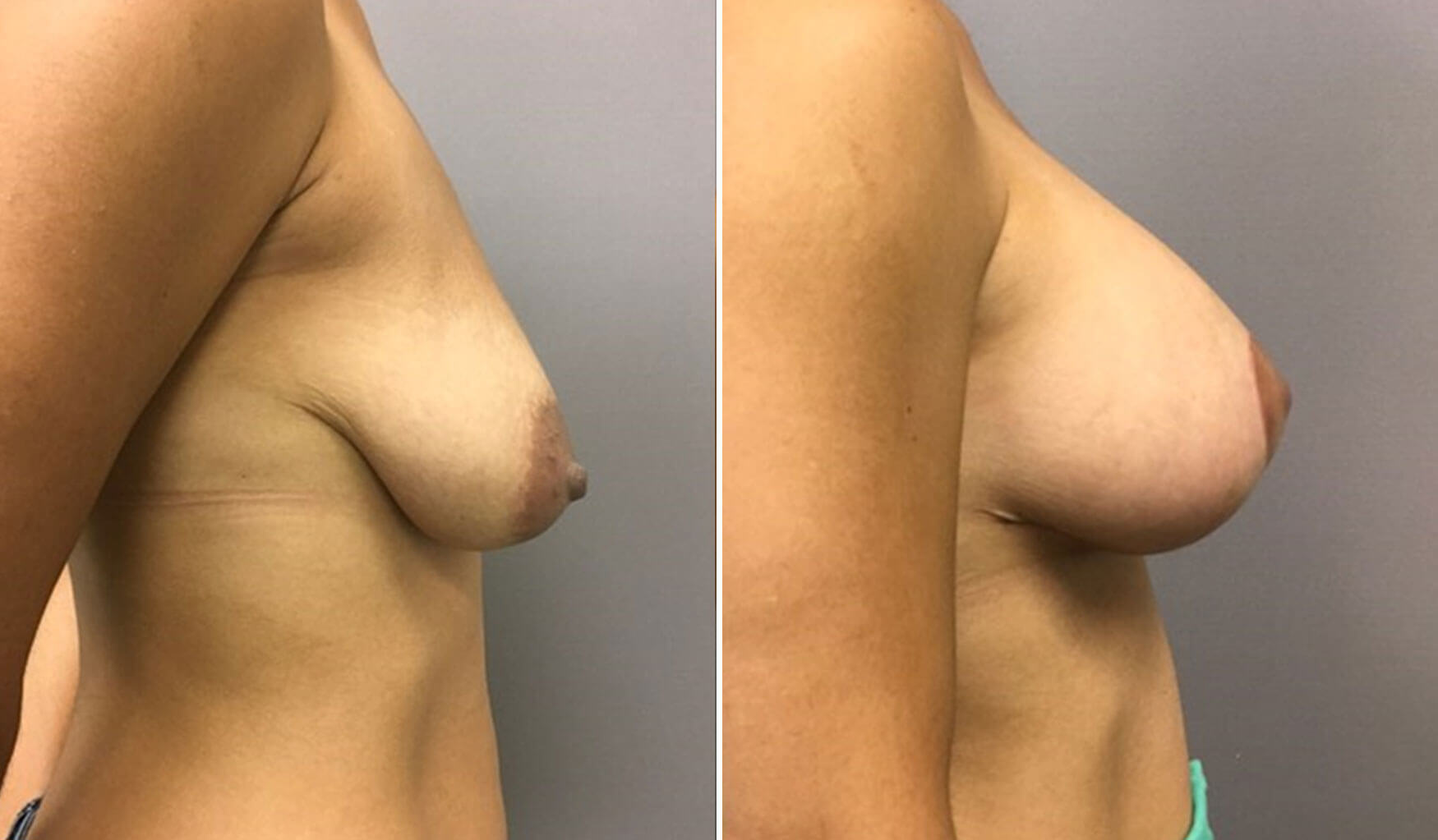 , Breast Lift with Augmentation