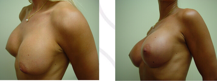 , Breast Revision Gallery