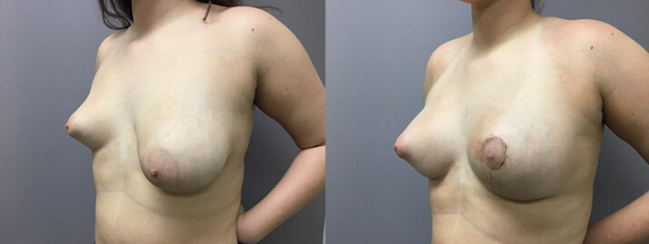 , Breast Lift Gallery