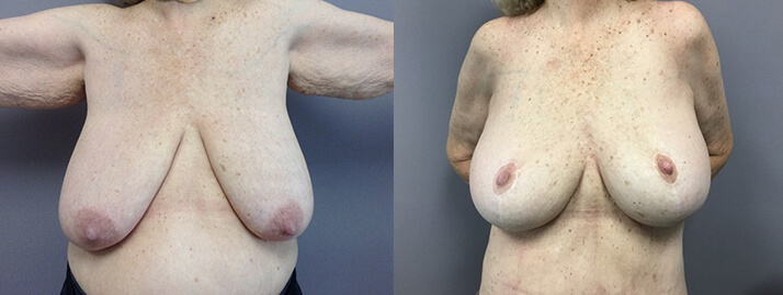 , Breast Lift with Augmentation