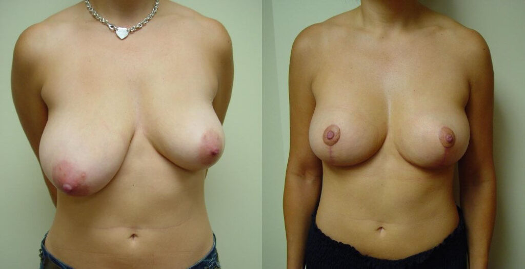 Breast Lift in Ft. Lauderdale, FL | eSSe Plastic Surgery