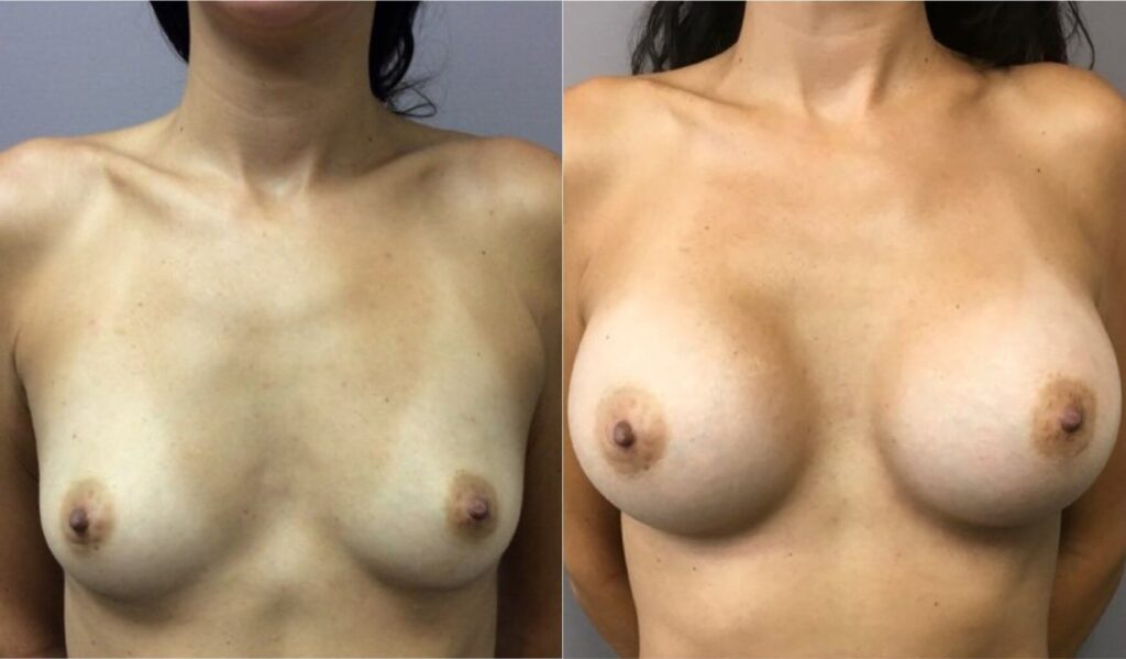 Breast Augmentation in Ft. Lauderdale, FL | eSSe Plastic Surgery