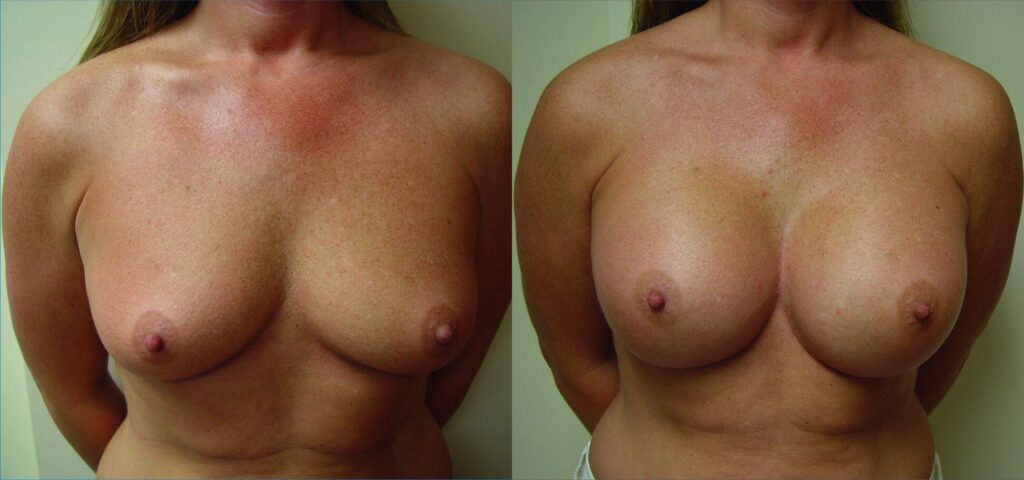 Breast Augmentation in Ft. Lauderdale, FL | eSSe Plastic Surgery