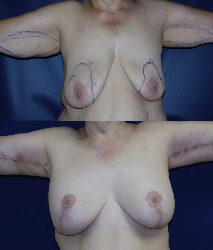 Breast Lift in Ft. Lauderdale, FL | eSSe Plastic Surgery