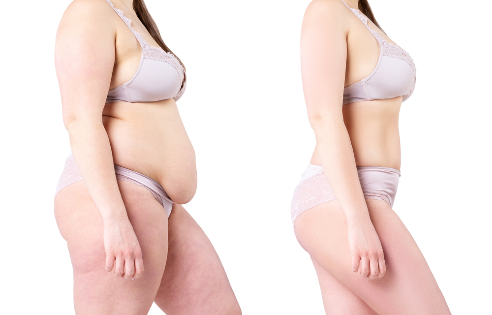 Your Tummy Tuck Timeline: How Long Should You Plan For? | eSSe Plastic Surgery