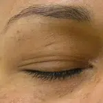 Before and After HydraFacial